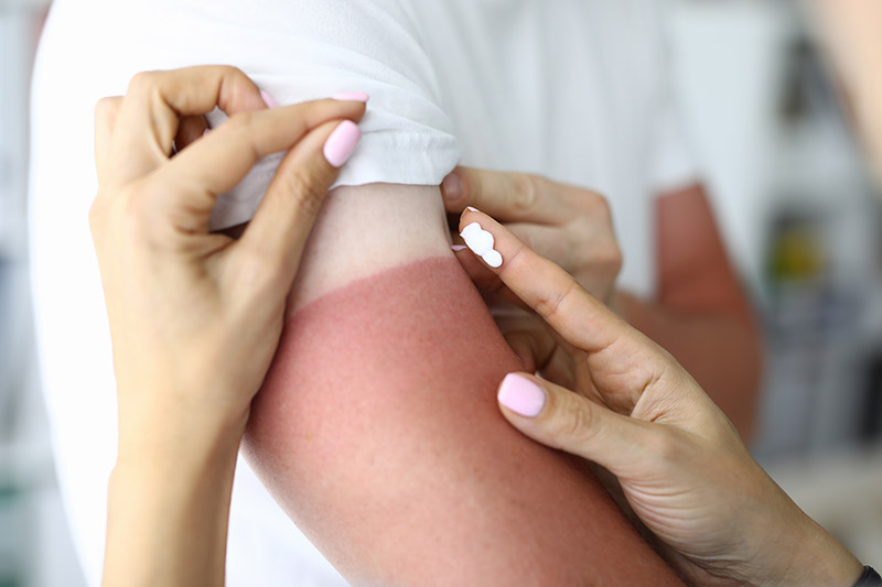 HugeDomains.com  Natural remedies for sunburn, Sunburn remedies