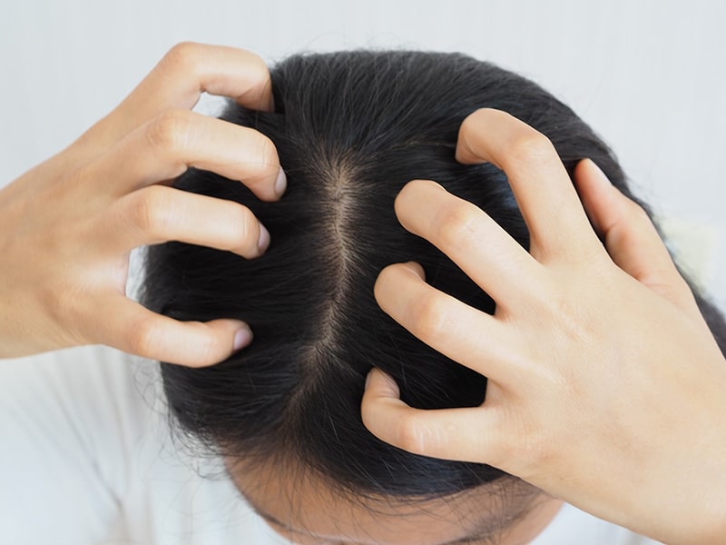 Scalp Ringworm: Symptoms, Causes, and Treatment- K Health