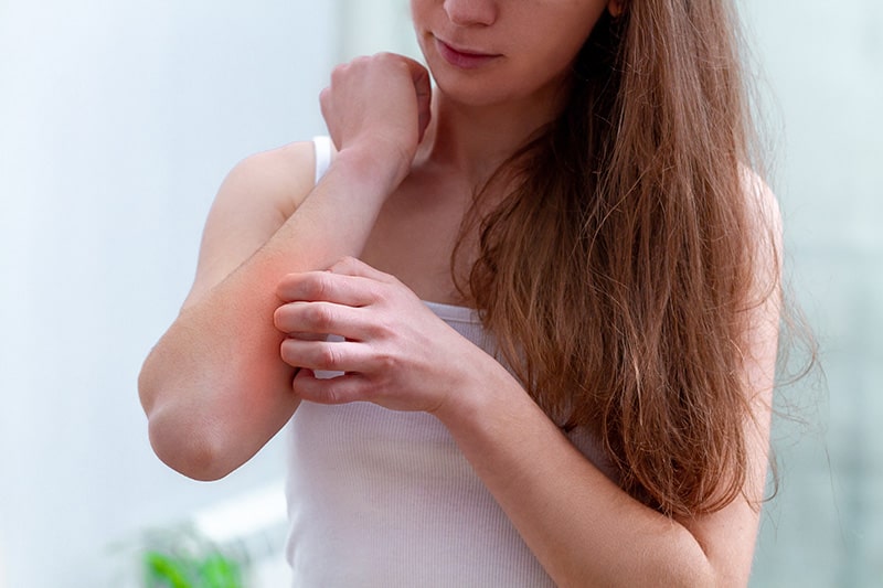 Eczema Flare Up Symptoms Triggers And Treatments K Health
