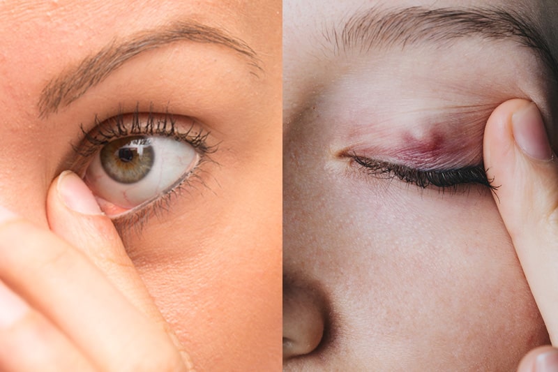 Chalazion Vs Styes What You Need To Know K Health