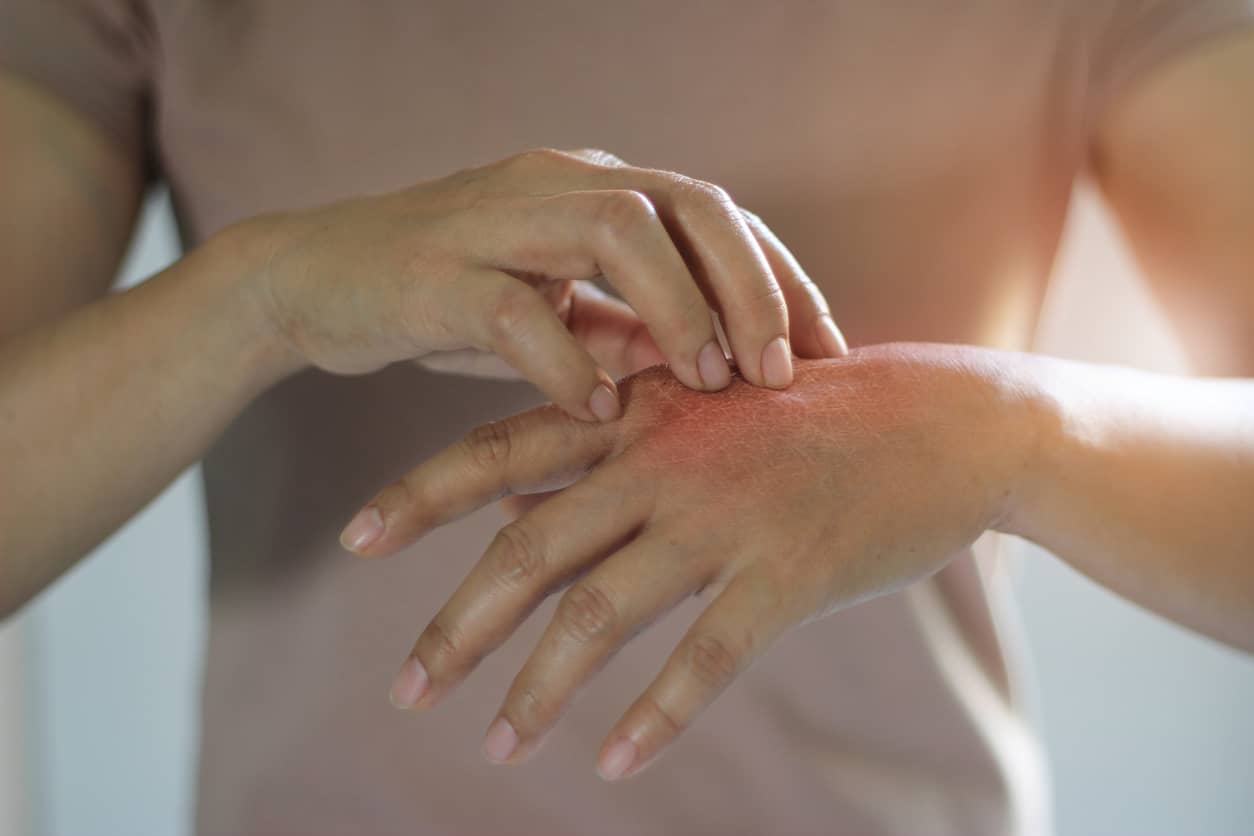 Dry Skin: Causes, Treatment, and Prevention - K Health