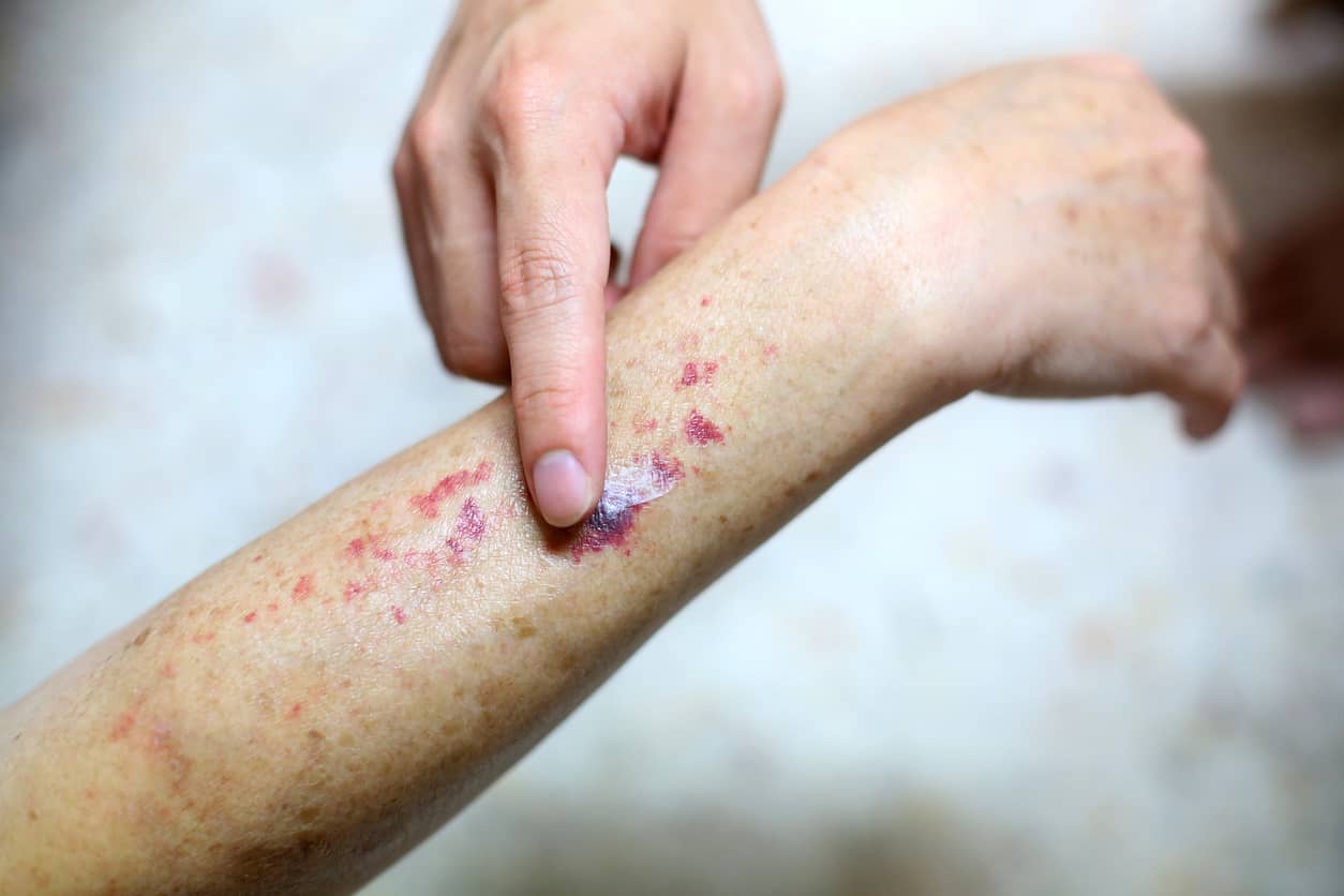 Purple Spots on Skin (Purpura) Causes, Treatment, and Diagnosis K Health