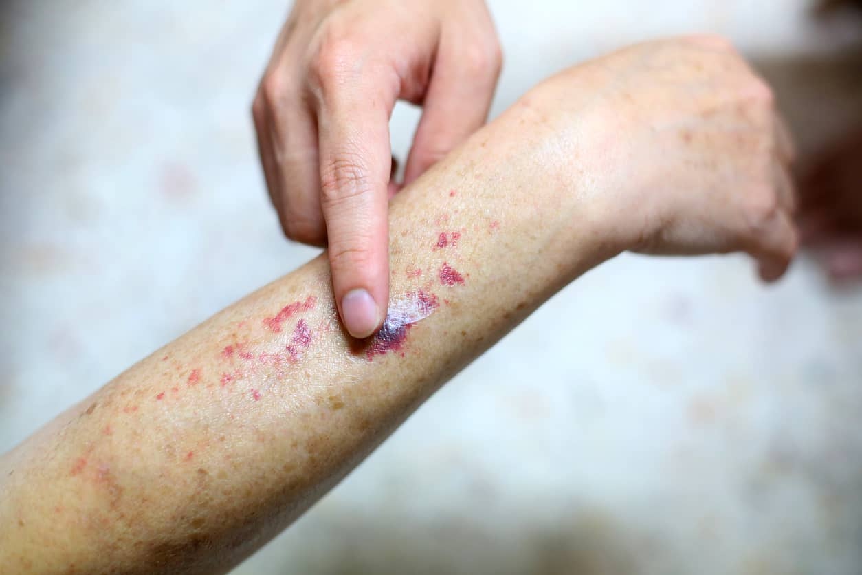 dark-red-spots-on-arm-vrogue-co