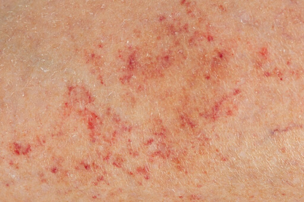 Petechiae: Learn Symptoms, Causes, and Treatments - K