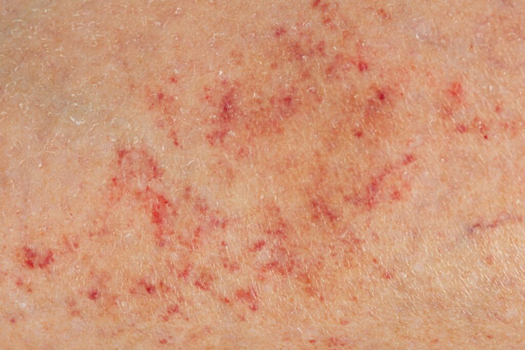 Petechiae on the skin 