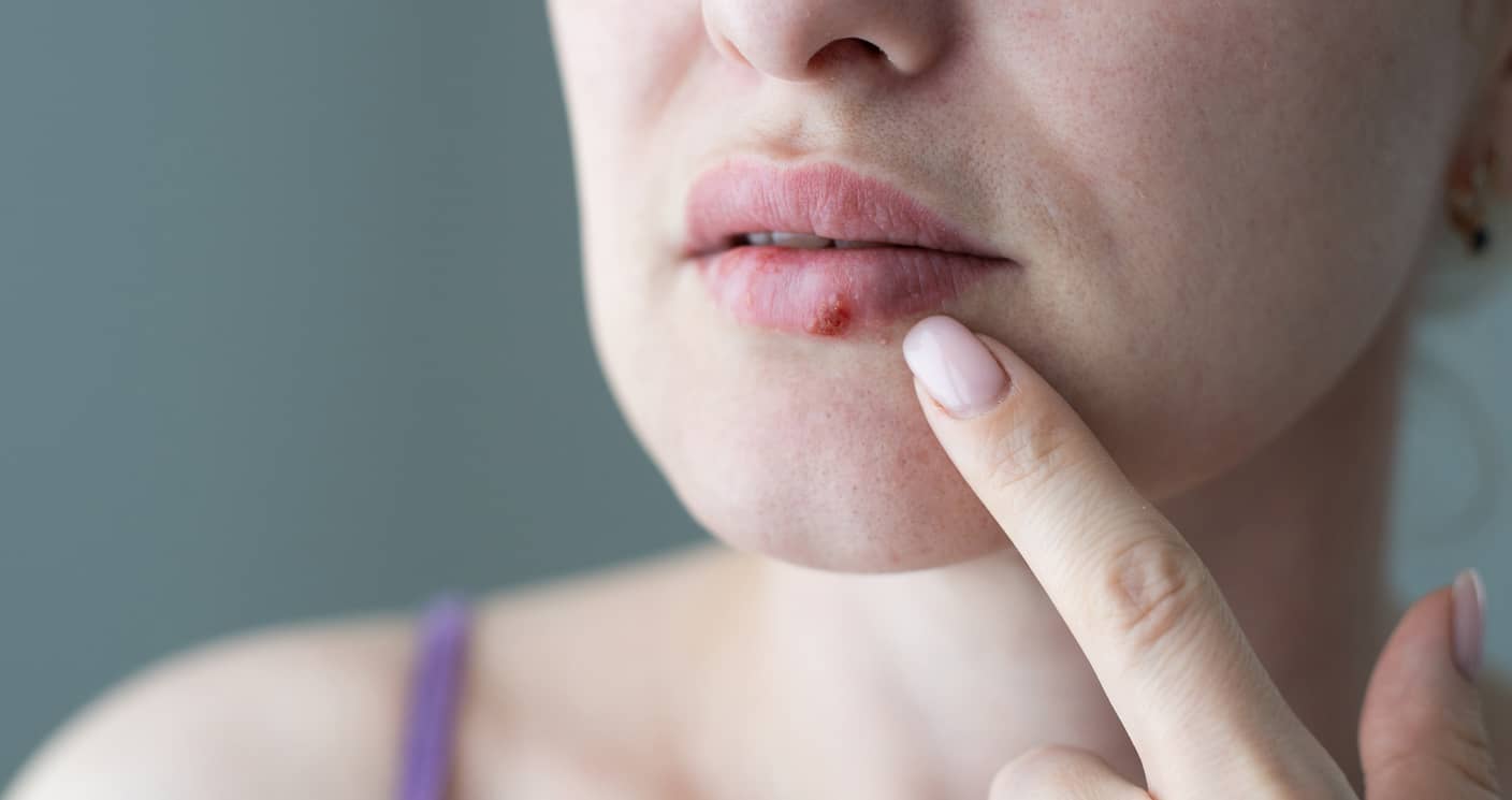 How To Heal Herpes On Tongue Fast